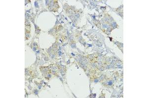 Immunohistochemistry of paraffin-embedded human mammary cancer using SOCS6 antibody (ABIN6128785, ABIN6148273, ABIN6148274 and ABIN6225294) at dilution of 1:100 (40x lens). (SOCS6 抗体  (AA 1-210))