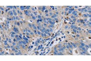 Immunohistochemistry of paraffin-embedded Human ovarian cancer tissue using GRIA3 Polyclonal Antibody at dilution 1:50 (Glutamate Receptor 3 抗体)