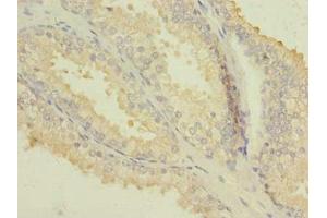 Immunohistochemistry of paraffin-embedded human prostate cancer using ABIN7163163 at dilution of 1:100 (PIK3R1 抗体  (Regulatory Subunit A))