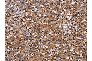 The image on the left is immunohistochemistry of paraffin-embedded Human prostate cancer tissue using ABIN7130450(NPM3 Antibody) at dilution 1/60, on the right is treated with fusion protein. (NPM3 抗体)