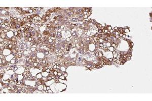 ABIN6272902 at 1/100 staining Human liver cancer tissue by IHC-P. (MPP5 抗体  (C-Term))