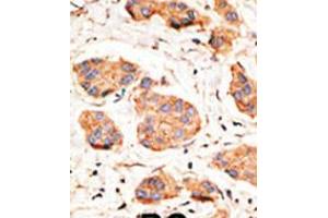 Formalin-fixed and paraffin-embedded human cancer tissue reacted with the primary antibody, which was peroxidase-conjugated to the secondary antibody, followed by DAB staining.
