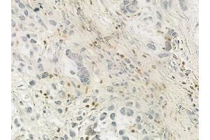 ABIN6263313 and ABIN6276953 at 1/100 staining human gastric carcinoma by IHC-P.