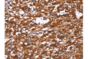 The image on the left is immunohistochemistry of paraffin-embedded Human thyroid cancer tissue using ABIN7190842(GPHN Antibody) at dilution 1/30, on the right is treated with synthetic peptide. (Gephyrin 抗体)