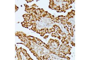Immunohistochemistry of paraffin-embedded human thyroid cancer using HMGCS2 antibody (ABIN7265329) at dilution of 1:100 (40x lens). (HMGCS2 抗体  (AA 269-508))