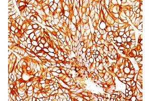 Formalin-fixed, paraffin-embedded human Colon Carcinoma stained with Cytokeratin 18 Mouse Monoclonal Antibody (DA7). (Cytokeratin 18 抗体)