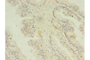 Immunohistochemistry of paraffin-embedded human prostate cancer using ABIN7159988 at dilution of 1:100 (MAPK13 抗体  (AA 1-365))