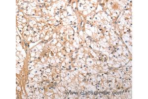 Immunohistochemistry of Human lung cancer using HCRTR1 Polyclonal Antibody at dilution of 1:100 (HCRTR1 抗体)