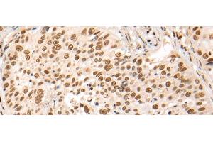 Immunohistochemistry of paraffin-embedded Human lung cancer tissue using HOXA7 Polyclonal Antibody at dilution of 1:70(x200) (HOXA7 抗体)