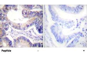 Immunohistochemical analysis of paraffin-embedded human colon carcinoma tissue using ACACA polyclonal antibody . (Acetyl-CoA Carboxylase alpha 抗体  (Ser80))