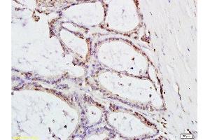 Formalin-fixed and paraffin embedded: human colon carcinoma labeled with Anti-MTLC Polyclonal Antibody , Unconjugated at 1:200, followed by conjugation to the secondary antibody and DAB staining (Myc Target 1 抗体  (AA 21-100))