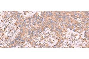 Immunohistochemistry of paraffin-embedded Human ovarian cancer tissue using EEF1D Polyclonal Antibody at dilution of 1:65(x200) (EEF1D 抗体)