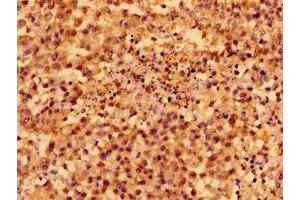 Immunohistochemistry of paraffin-embedded human colon cancer using ABIN7160238 at dilution of 1:100