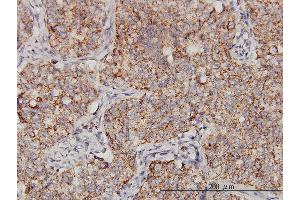 Immunoperoxidase of monoclonal antibody to PPOX on formalin-fixed paraffin-embedded human lung, adenosquamous cell carcinoma. (PPOX 抗体  (AA 378-477))