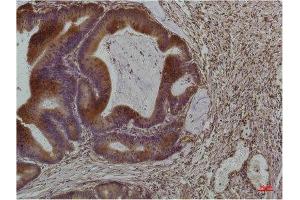 Immunohistochemistry (IHC) analysis of paraffin-embedded Human Colon Carcinoma using Smad3 Mouse Monoclonal Antibody diluted at 1:200. (SMAD3 抗体)