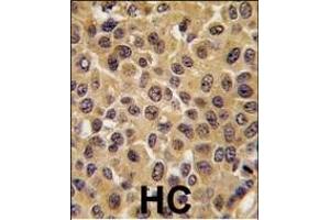 Formalin-fixed and paraffin-embedded human breast carcinoma tissue reacted with CDC25B antibody (Center), which was peroxidase-conjugated to the secondary antibody, followed by DAB staining. (CDC25B 抗体  (AA 331-360))