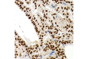Immunohistochemistry of paraffin-embedded human thyroid cancer using MT2A antibody (ABIN1873764) at dilution of 1:200 (40x lens). (MT2A 抗体)