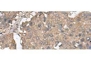 Immunohistochemistry of paraffin-embedded Human liver cancer tissue using EIF4A2 Polyclonal Antibody at dilution of 1:65(x200) (EIF4A2 抗体)