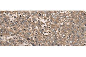 Immunohistochemistry of paraffin-embedded Human liver cancer tissue using CDC20B Polyclonal Antibody at dilution of 1:30(x200) (CDC20B 抗体)