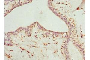 Immunohistochemistry of paraffin-embedded human breast cancer using ABIN7158965 at dilution of 1:100 (Mammaglobin A 抗体  (AA 1-93))