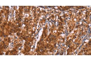 Immunohistochemistry of paraffin-embedded Human gastric cancer using BRK1 Polyclonal Antibody at dilution of 1:40 (BRK1 抗体)