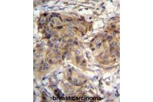 TTC9C Antibody (N-term) immunohistochemistry analysis in formalin fixed and paraffin embedded human breast carcinoma followed by peroxidase conjugation of the secondary antibody and DAB staining. (TTC9C 抗体  (N-Term))