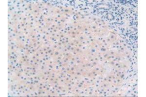 IHC-P analysis of Human Liver Cancer Tissue, with DAB staining. (TLR3 抗体  (AA 404-532))