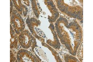 Immunohistochemical analysis of paraffin-embedded Human colon cancer tissue using at dilution 1/70. (SUN5 抗体  (Internal Region))