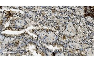 IHC analysis of Transketolase/TKT using anti-Transketolase/TKT antibody (ABIN7598958).