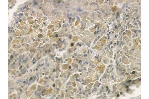 ABIN6257230 and ABIN6273665 at 1/100 staining human lung squamous cell carcinoma by IHC-P.