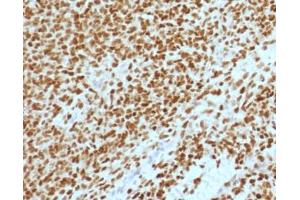 IHC testing of FFPE Ewings sarcoma with NKX2. (Nkx2-2 抗体  (AA 1-119))