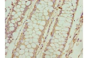 Immunohistochemistry of paraffin-embedded human colon cancer using ABIN7152907 at dilution of 1:100 (FSIP1 抗体  (AA 101-400))