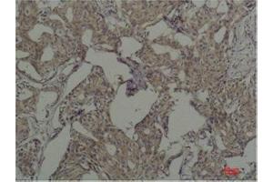 Immunohistochemistry (IHC) analysis of paraffin-embedded Human Breast Carcicnoma using c-Fos Mouse Monoclonal Antibody diluted at 1:200. (c-FOS 抗体)