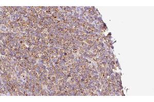 ABIN6273185 at 1/100 staining Human lymph cancer tissue by IHC-P. (WBP2NL 抗体  (Internal Region))