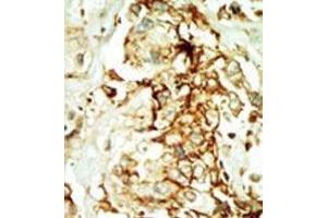 Formalin-fixed and paraffin-embedded human cancer tissue (breast carcinoma) reacted with the primary antibody, which was peroxidase-conjugated to the secondary antibody, followed by DAB staining. (MAPK10 抗体  (N-Term))