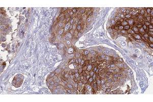 ABIN6277433 at 1/100 staining Human urothelial cancer tissue by IHC-P. (SLC1A4 抗体  (C-Term))