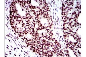 Immunohistochemical analysis of paraffin-embedded ovarian cancer tissues using WHSC2 mouse mAb with DAB staining. (WHSC2 抗体  (AA 280-511))