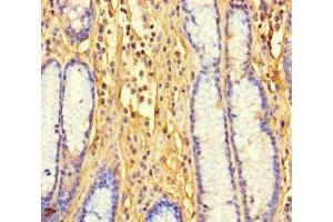 Immunohistochemistry of paraffin-embedded human gastric cancer using ABIN7165770 at dilution of 1:100 (LTV1 抗体  (AA 201-475))