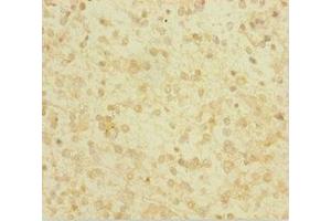 Immunohistochemistry of paraffin-embedded human glioma using ABIN7154046 at dilution of 1:100 (Glutaredoxin 1 抗体  (AA 1-106))