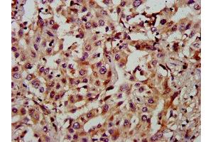 IHC image of ABIN7160745 diluted at 1:900 and staining in paraffin-embedded human liver cancer performed on a Leica BondTM system. (FAM174A 抗体  (AA 1-94))