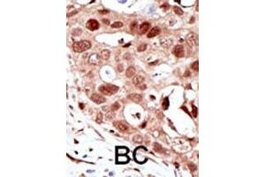 Formalin-fixed and paraffin-embedded human cancer tissue reacted with the primary antibody, which was peroxidase-conjugated to the secondary antibody, followed by AEC staining. (SUMO2 抗体  (C-Term))
