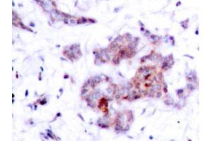 Immunohistochemical analysis of paraffin-embedded human breast cancer tissue using REL polyclonal antibody . (c-Rel 抗体)