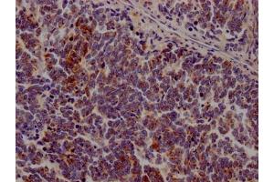 IHC image of ABIN7127588 diluted at 1:100 and staining in paraffin-embedded human lung cancer performed on a Leica BondTM system. (Recombinant JAK3 抗体)