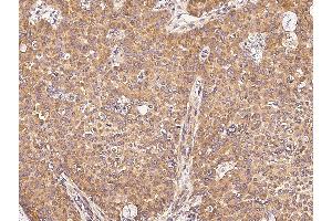Immunochemical staining of human UBE4A in human breast carcinoma with rabbit polyclonal antibody (0. (豚鼠 anti-兔 IgG (Heavy & Light Chain) Antibody (Alkaline Phosphatase (AP)) - Preadsorbed)
