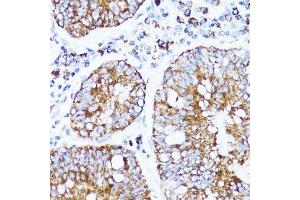 Immunohistochemistry of paraffin-embedded human colon carcinoma using CYCS antibody. (Cytochrome C 抗体  (AA 1-105))