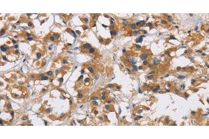 Immunohistochemistry of paraffin-embedded Human thyroid cancer tissue using CYP21A2 Polyclonal Antibody at dilution 1:60 (CYP21A2 抗体)