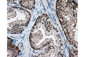 Immunohistochemical staining of paraffin-embedded Adenocarcinoma of colon tissue using anti-SRR mouse monoclonal antibody. (SRR 抗体)