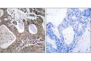 Immunohistochemistry analysis of paraffin-embedded human colon carcinoma tissue, using STEA2 Antibody. (STEAP2 抗体  (AA 431-480))