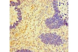 Immunohistochemistry of paraffin-embedded human ovarian cancer using ABIN7150987 at dilution of 1:100