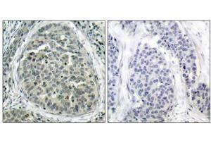 Immunohistochemical analysis of paraffin-embedded human breast carcinoma tissue, using β-Catenin (phospho-Ser37) antibody (E011219). (beta Catenin 抗体  (pSer37))